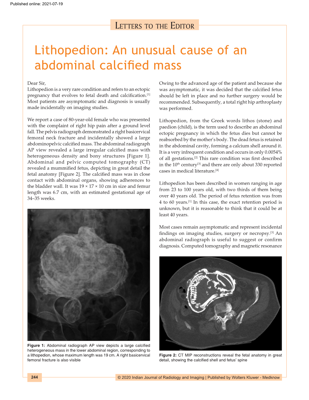 Lithopedion: an Unusual Cause of an Abdominal Calcified Mass
