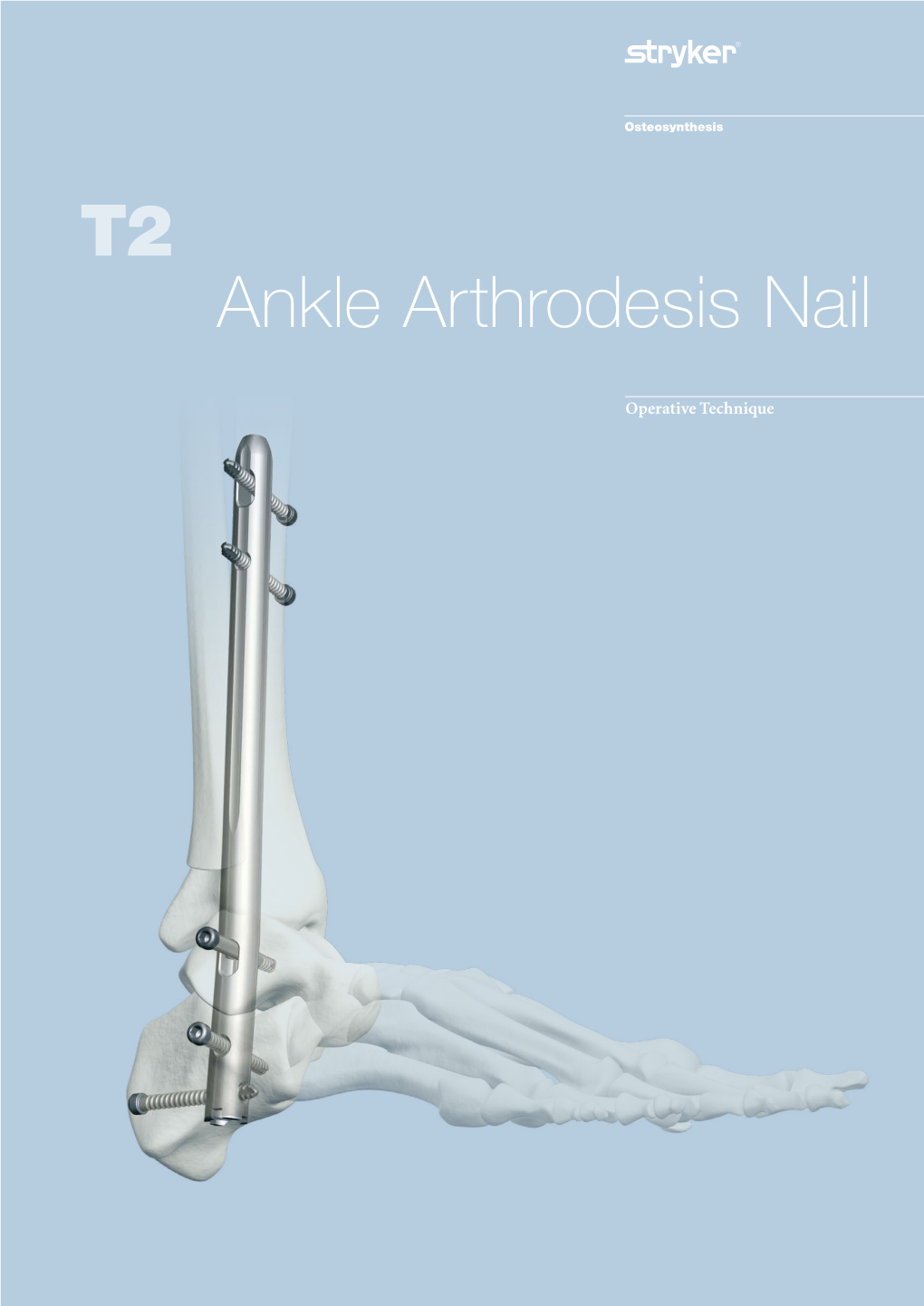 T2 Ankle Arthrodesis Nail