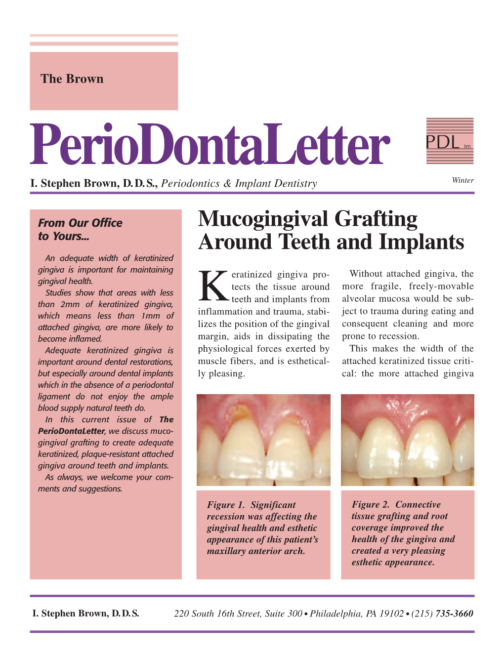 Mucogingival Grafting Around Teeth and Implants