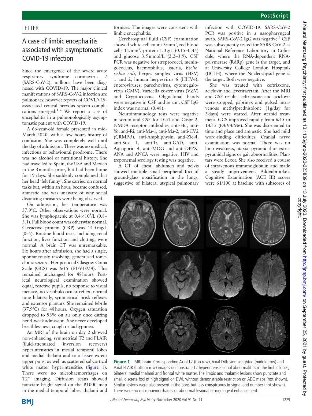 A Case of Limbic Encephalitis Associated with Asymptomatic COVID-19 Infection