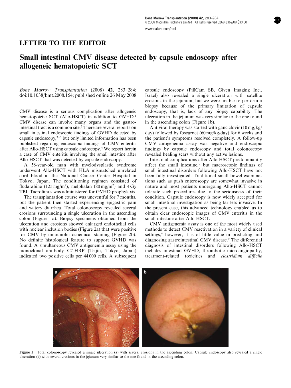 Small Intestinal CMV Disease Detected by Capsule Endoscopy After Allogeneic Hematopoietic SCT