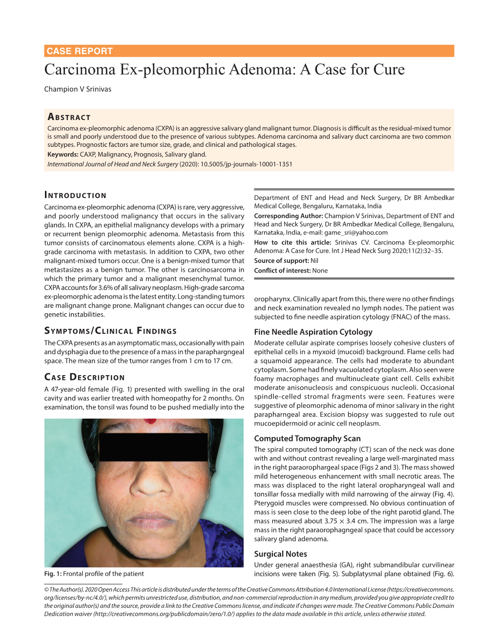 Carcinoma Ex-Pleomorphic Adenoma: a Case for Cure Champion V Srinivas