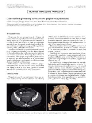 Gallstone Ileus Presenting As Obstructive Gangrenous Appendicitis