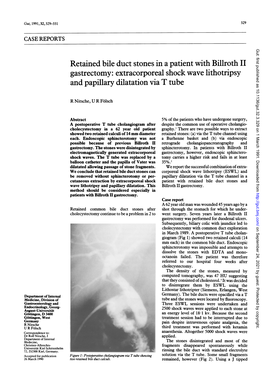 Retained Bile Duct Stones in a Patient with Billroth II Gastrectomy: Extracorporeal Shock Wave Lithotripsy and Papillary Dilatation Via T Tube