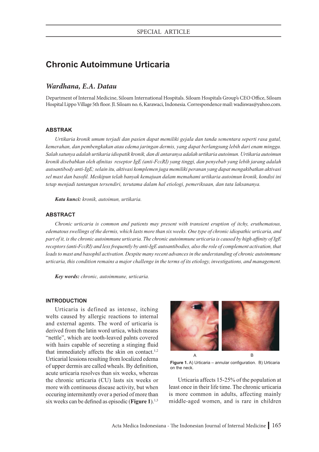 Chronic Autoimmune Urticaria