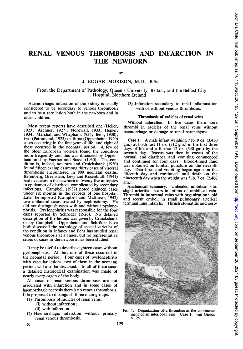 Renal Venous Thrombosis and Infarction in the Newborn