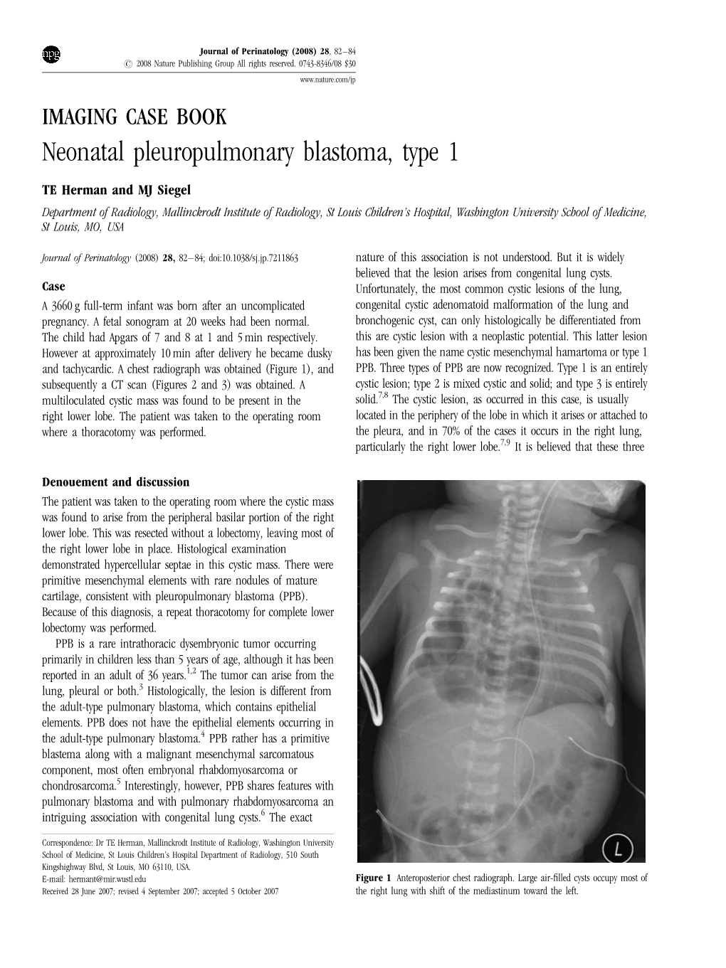 Neonatal Pleuropulmonary Blastoma, Type 1