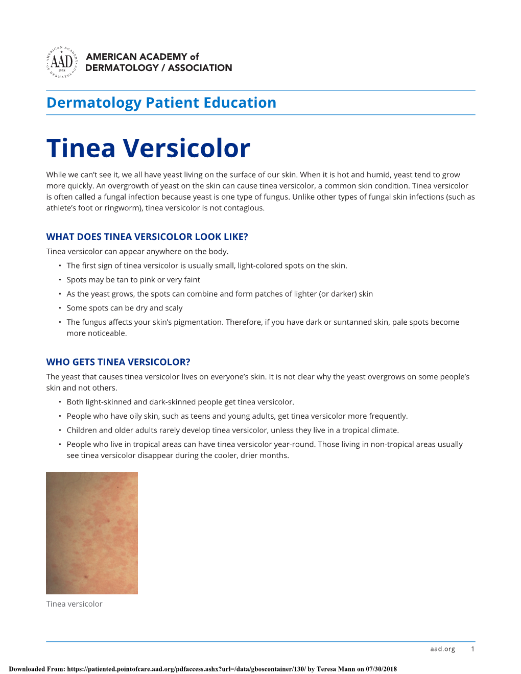 Tinea Versicolor While We Can’T See It, We All Have Yeast Living on the Surface of Our Skin