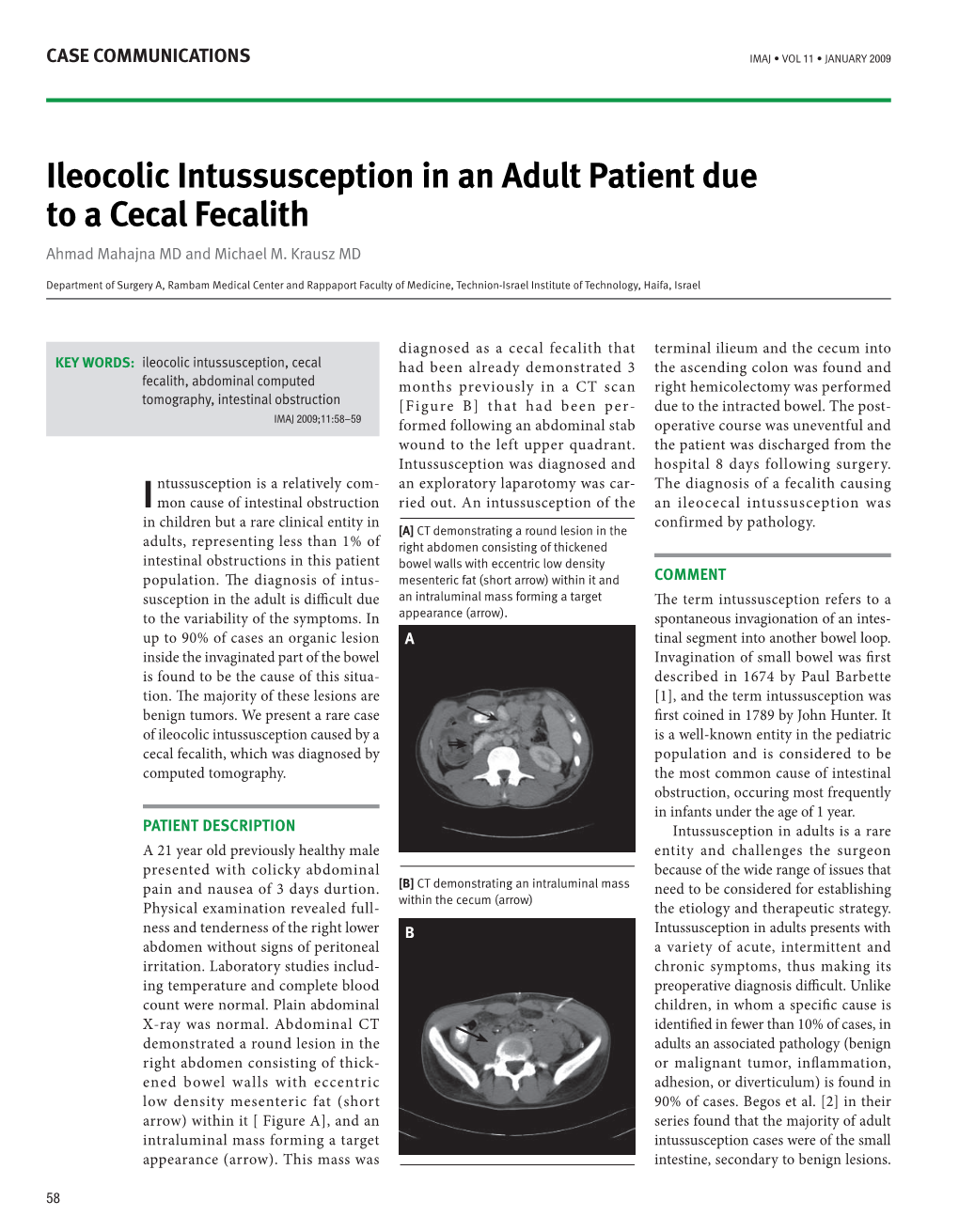 Ileocolic Intussusception in an Adult Patient Due to a Cecal Fecalith Ahmad Mahajna MD and Michael M