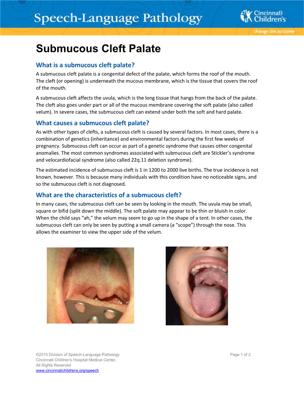 Submucous Cleft Palate