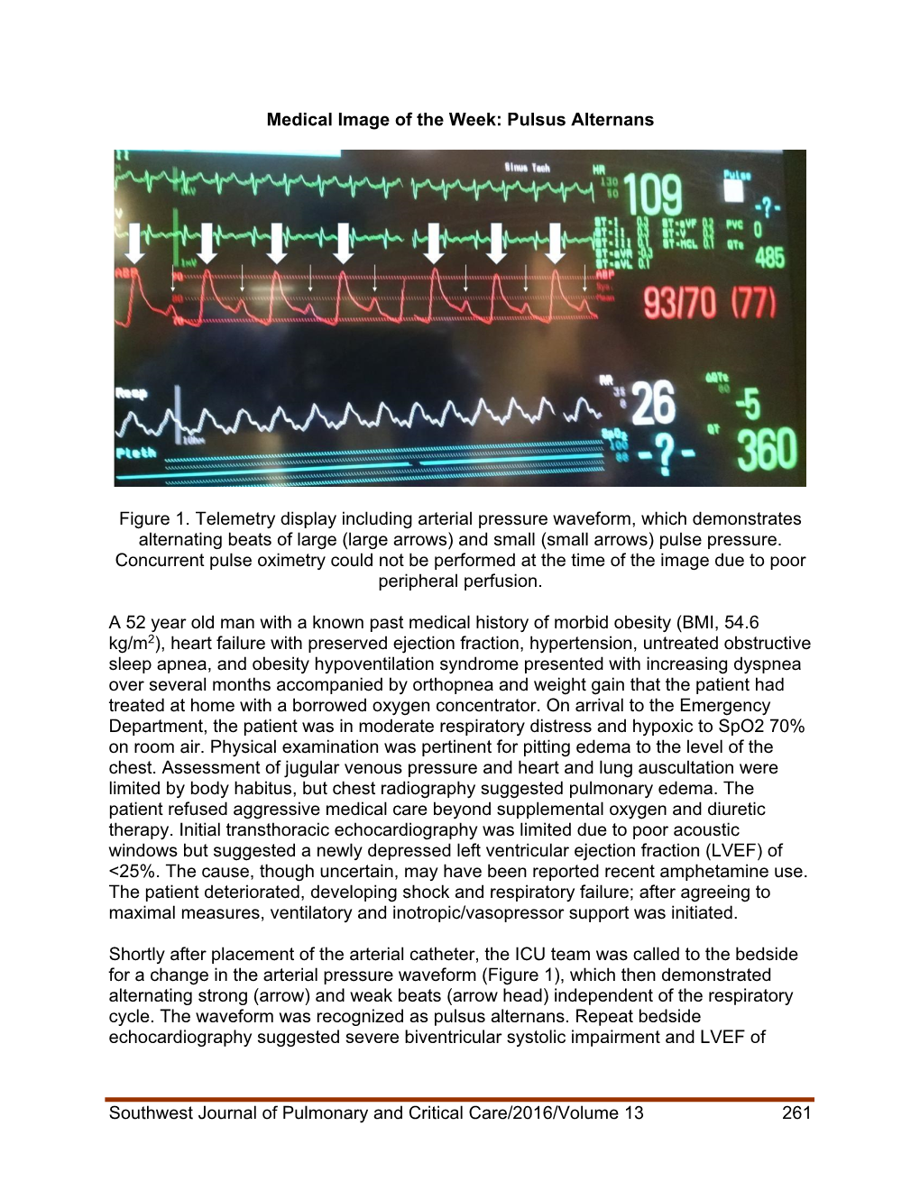 Pulsus Alternans Figure 1. Teleme