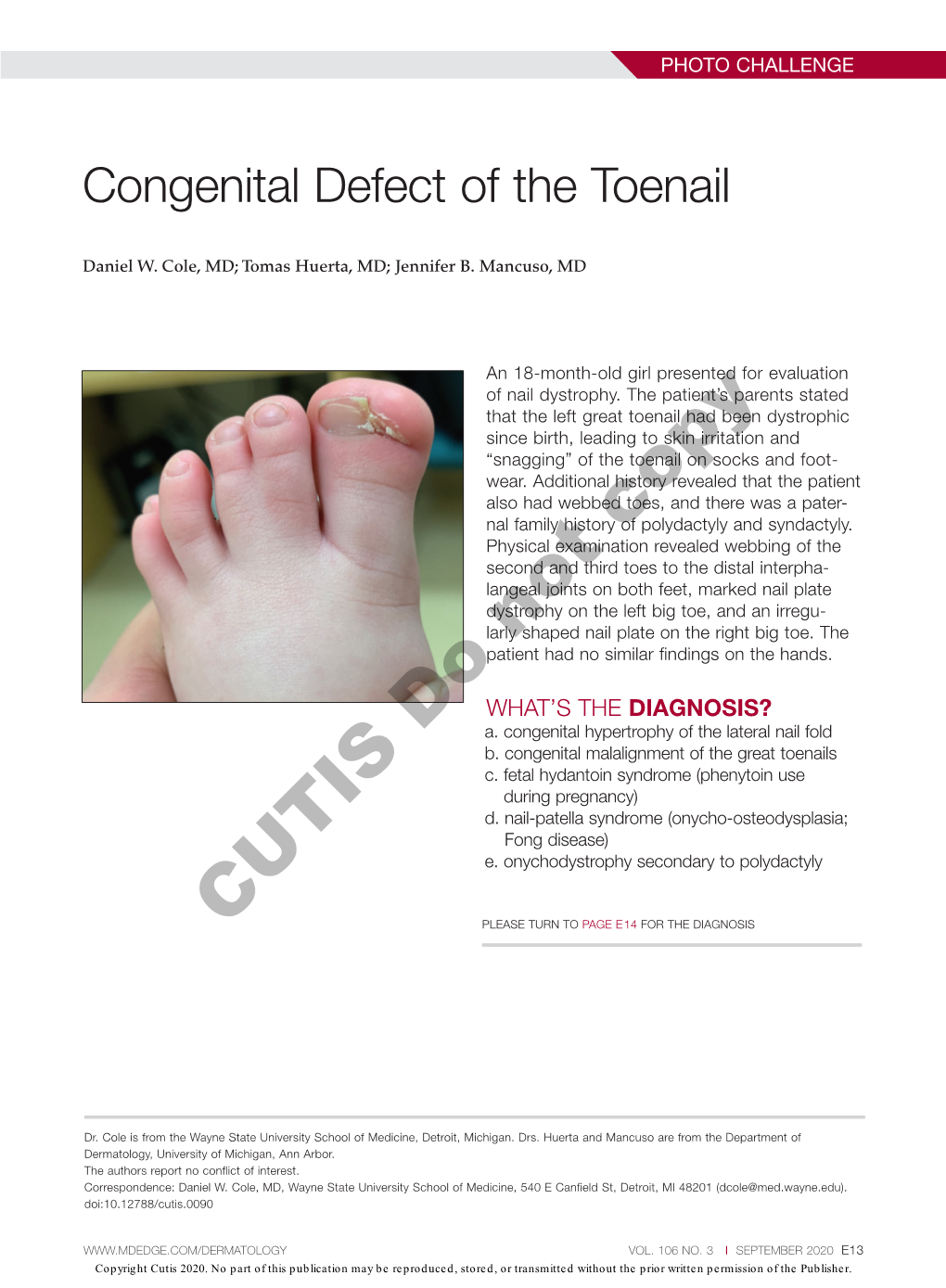Congenital Defect of the Toenail