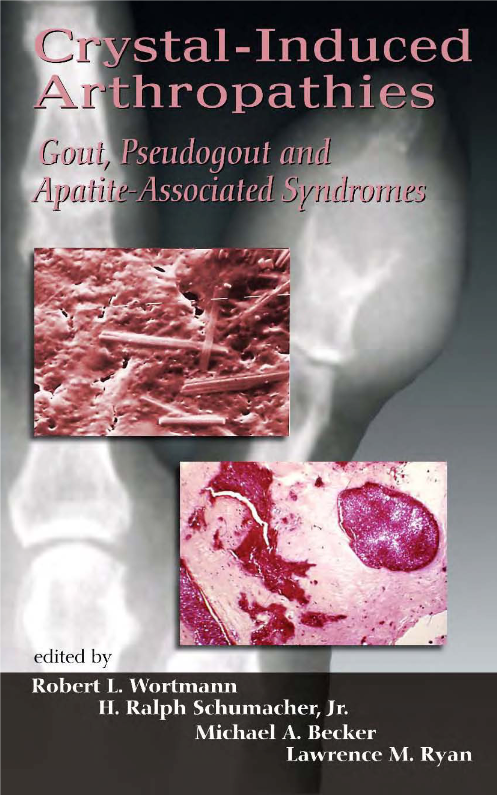 Gout, Pseudogout and Apatite-Associated Syndromes