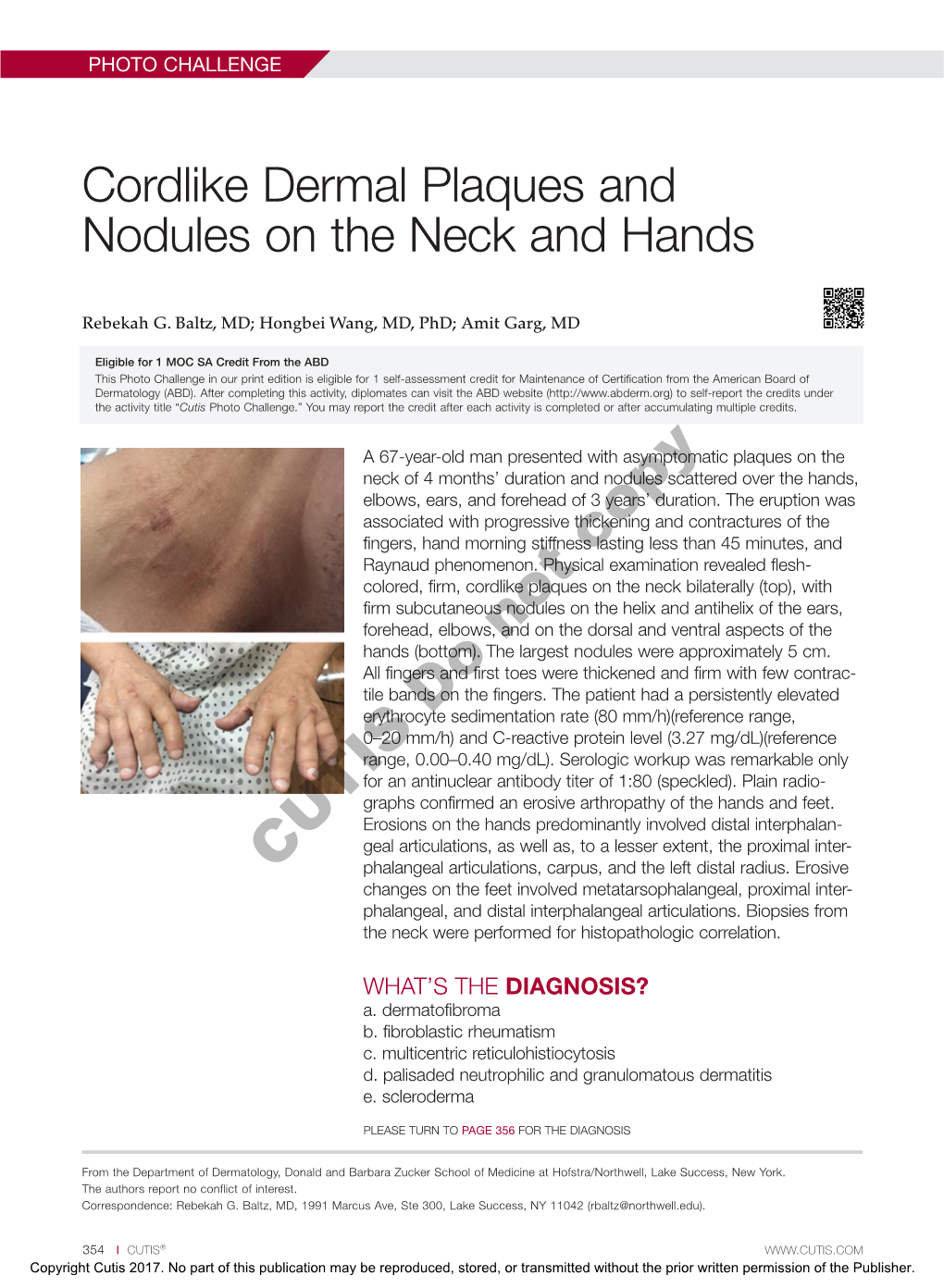 Cordlike Dermal Plaques and Nodules on the Neck and Hands