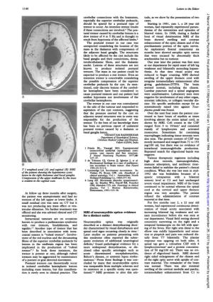 Neuromyelitis Optica Originally Described As a Distinct
