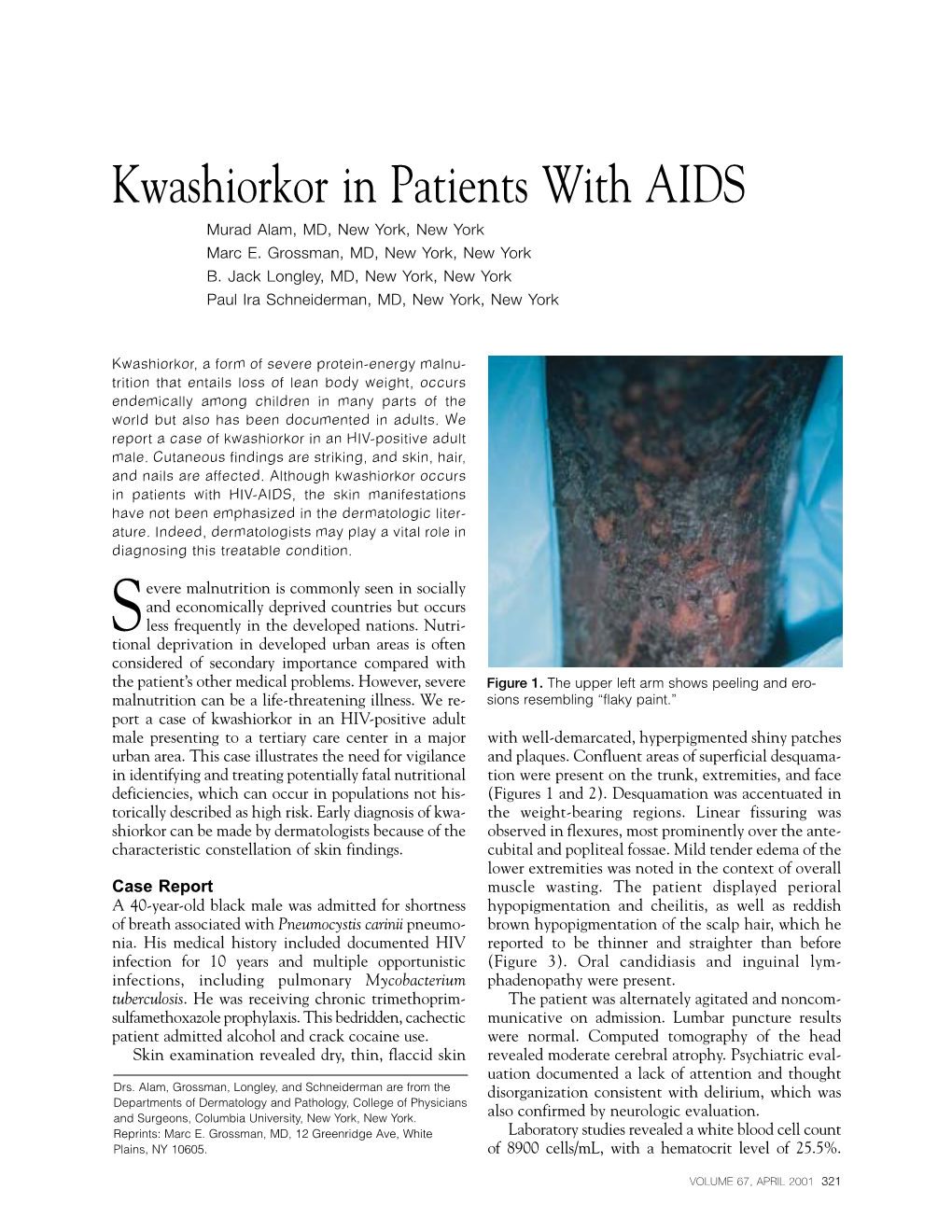 Kwashiorkor in Patients with AIDS Murad Alam, MD, New York, New York Marc E