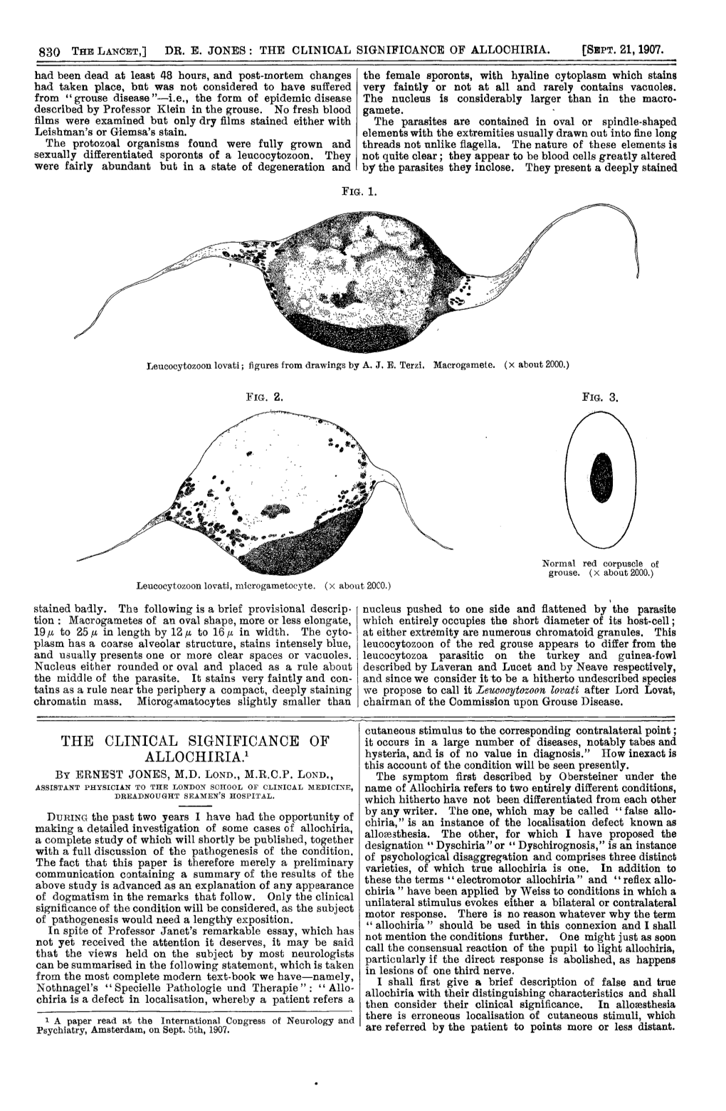 ALLOCHIRIA.1 Hysteria, and Is of No Value in Diagnosis.