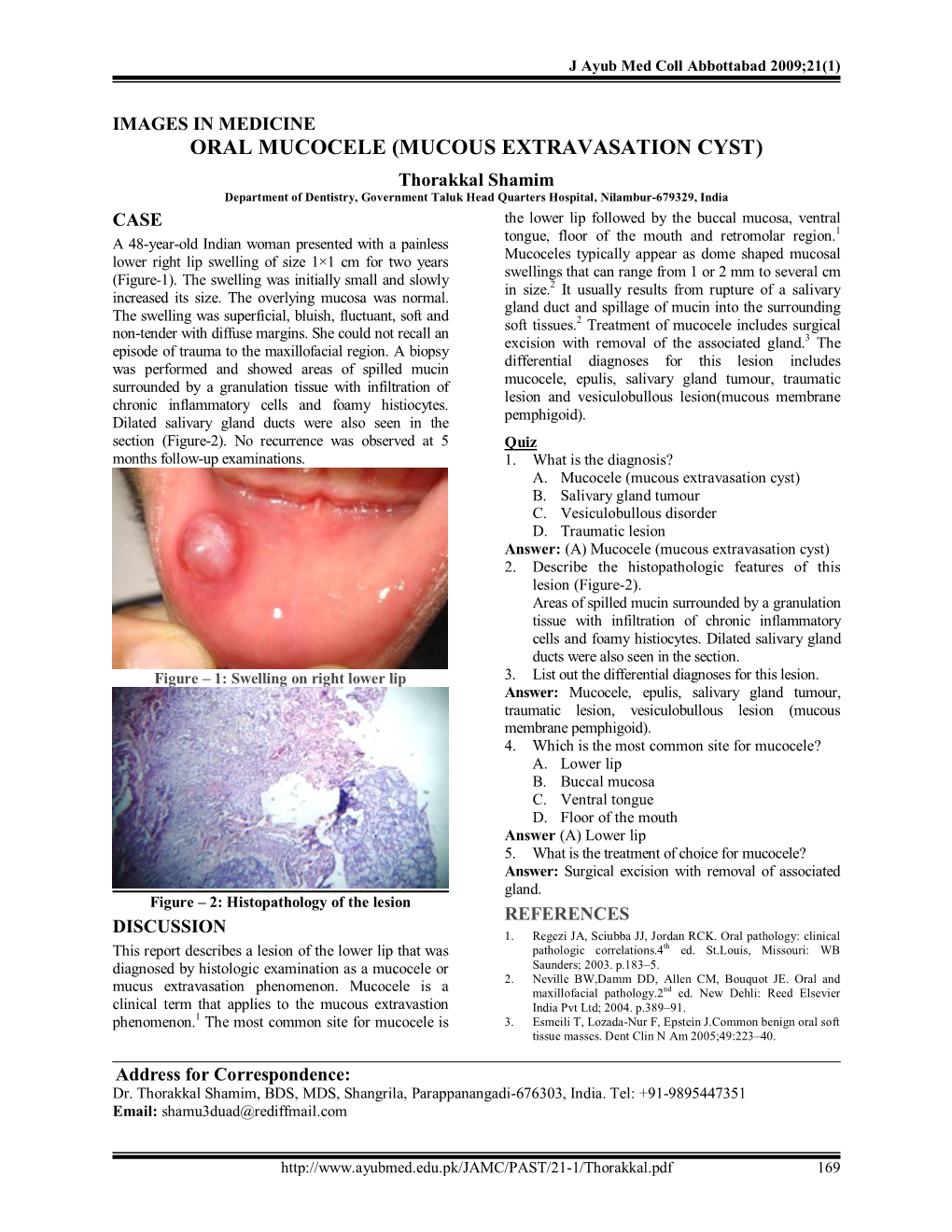 Oral Mucocele Mucous Extravasation Cyst Docslib