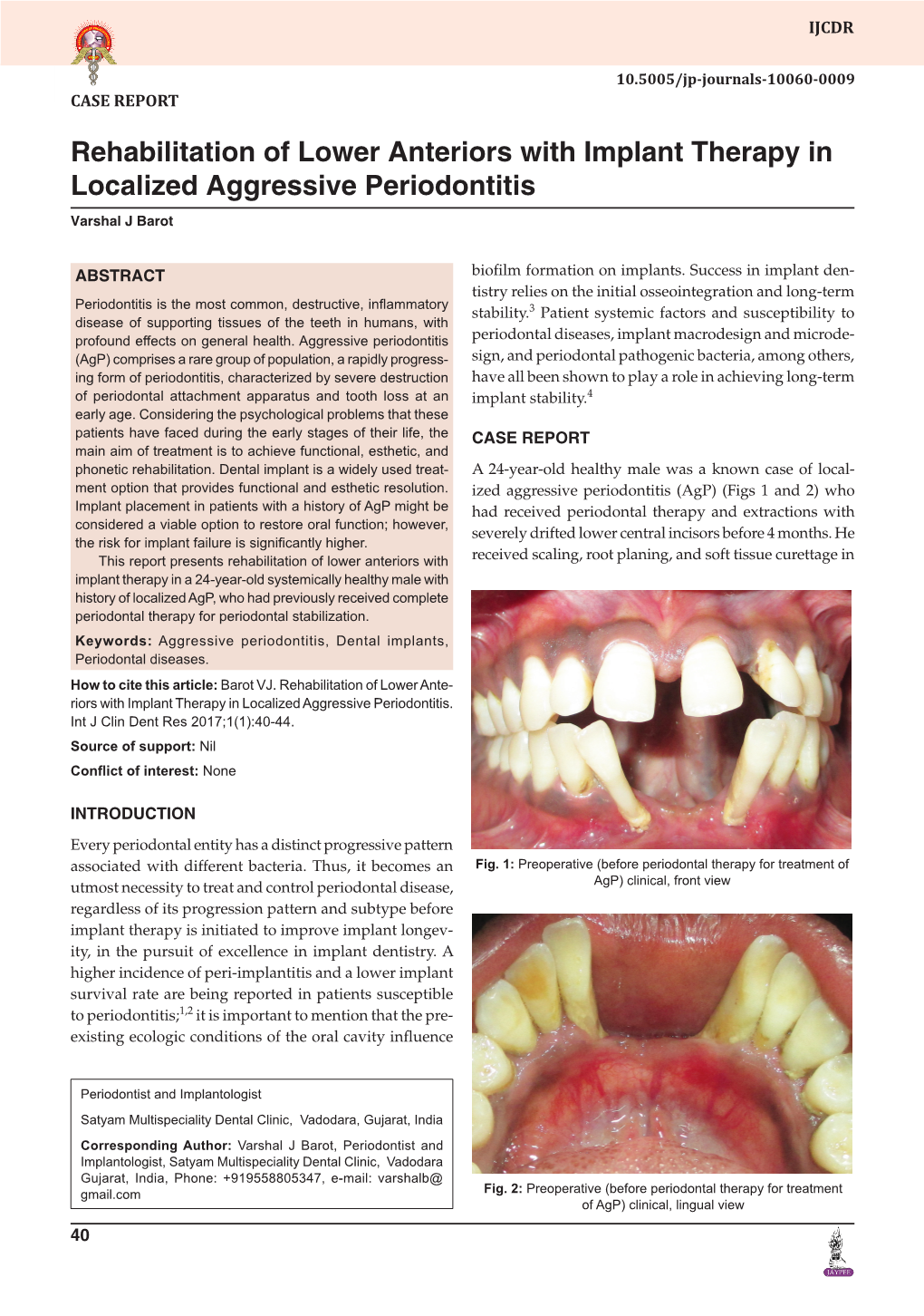 Rehabilitation of Lower Anteriors with Implant Therapy in Localized Aggressive Periodontitis Varshal J Barot
