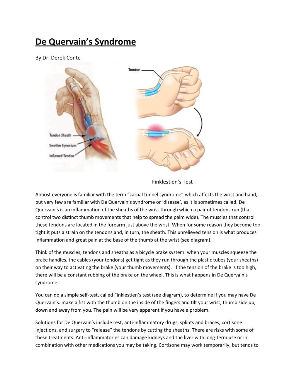 A Patients Guide To De Quervains Tendinopathy Hand And Upper Limb ...