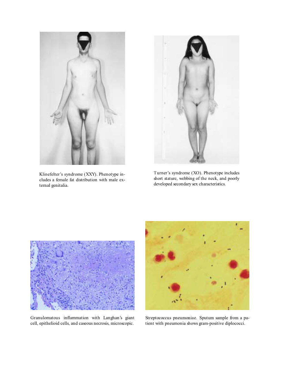 Klinefelter's Syndrome