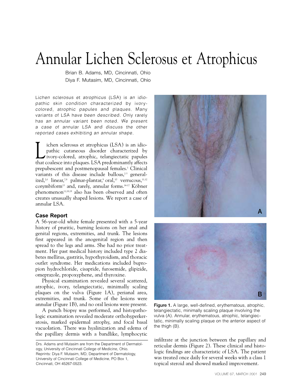 Annular Lichen Sclerosus Et Atrophicus Brian B