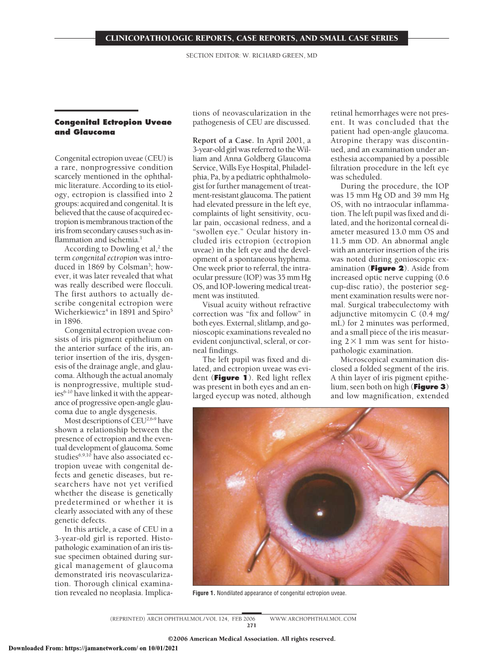 Congenital Ectropion Uveae and Glaucoma