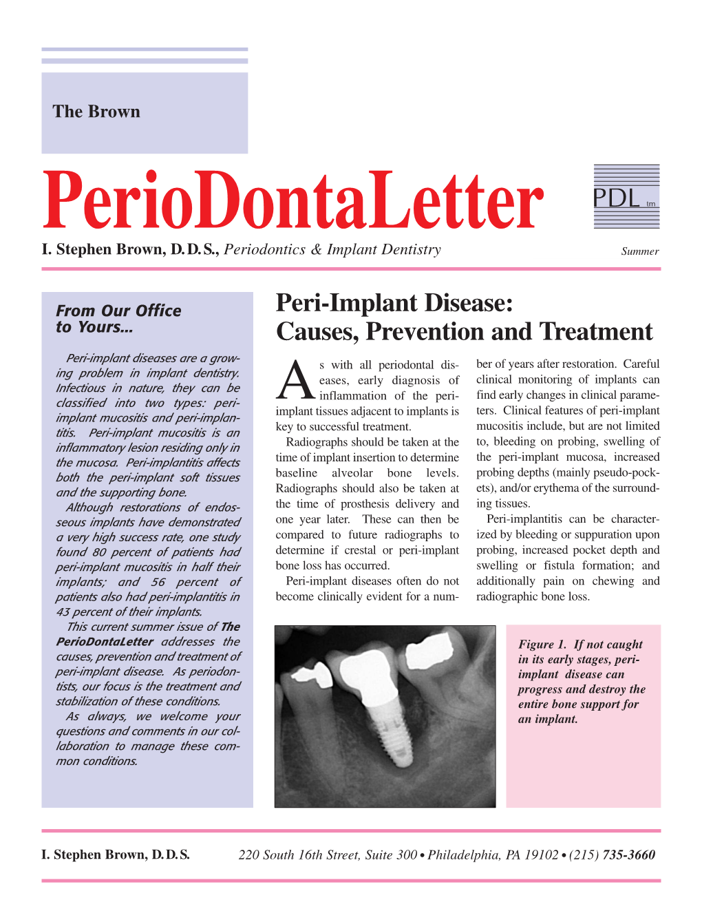 Peri Implant Disease