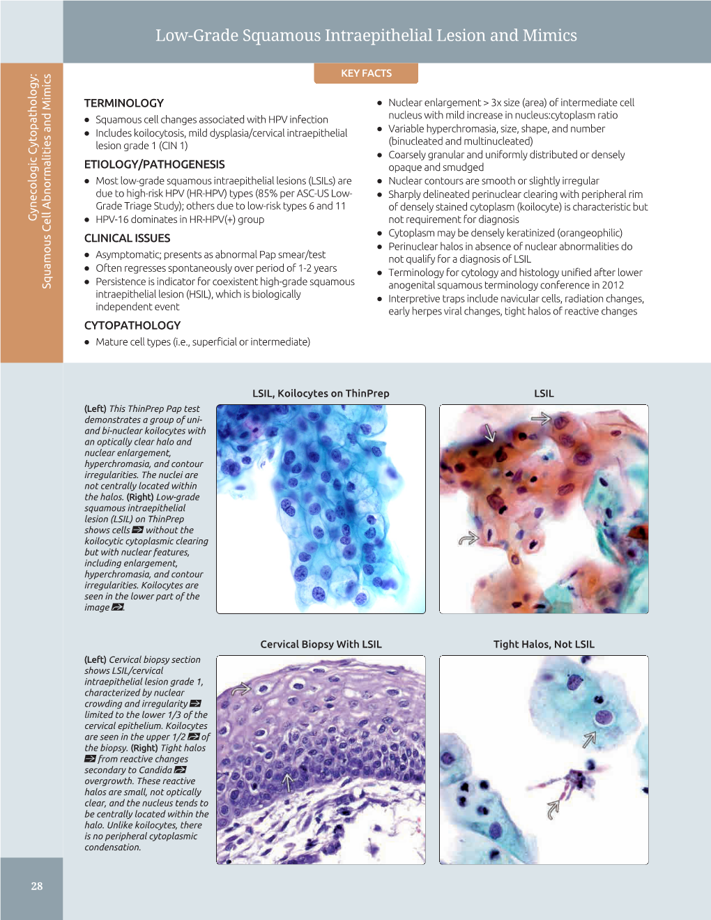 Low-Grade Squamous Intraepithelial Lesion and Mimics