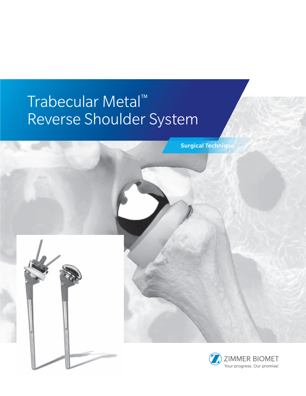 Trabecular Metal™ Reverse Shoulder System Surgical Technique