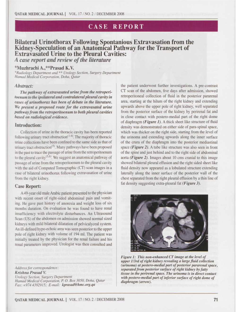 Bilateral Urinothorax Following Spontanious Extravasation from the Kidney-Speculation of an Anatomical Pathway for the Transport