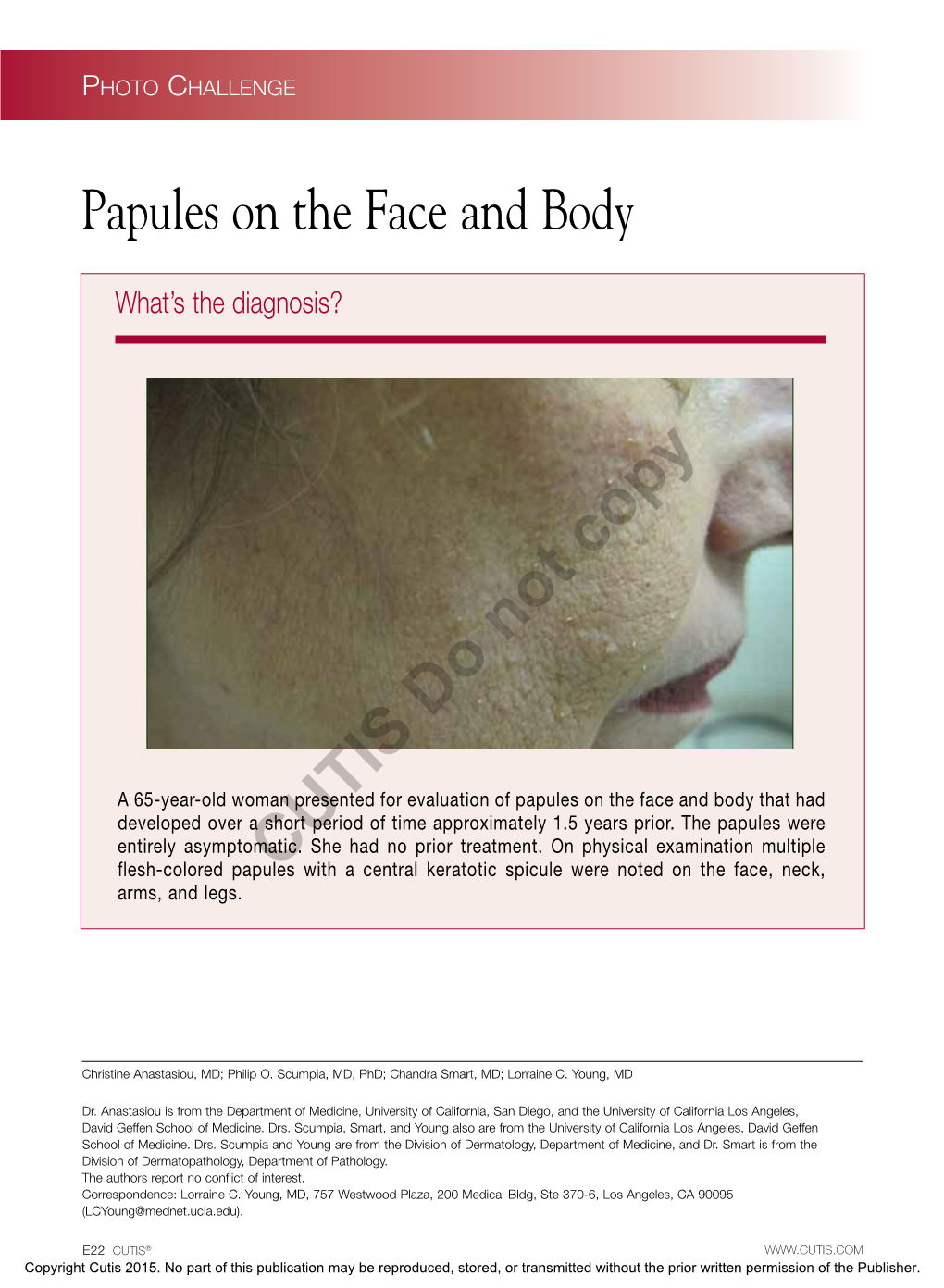 Papules on the Face and Body