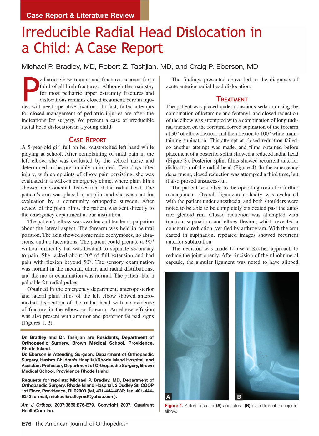 Irreducible Radial Head Dislocation in a Child: a Case Report