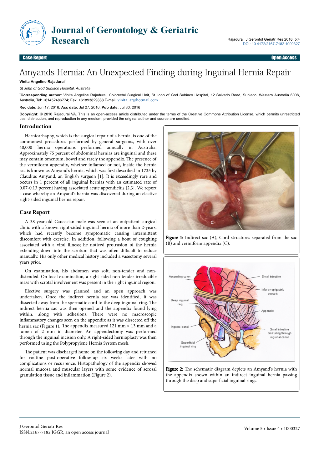 Amyands Hernia: an Unexpected Finding During Inguinal Hernia Repair