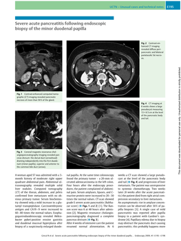 Severe Acute Pancreatitis Following Endoscopic Biopsy of the Minor Duodenal Papilla
