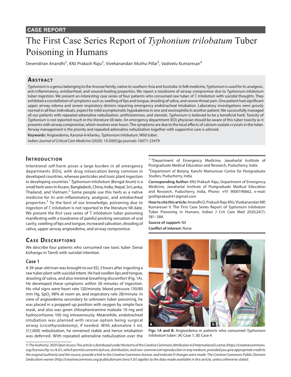 Typhonium Trilobatum Tuber Poisoning in Humans Devendiran Anandhi1, KNJ Prakash Raju2, Vivekanandan Muthu Pillai3, Vadivelu Kumaresan4