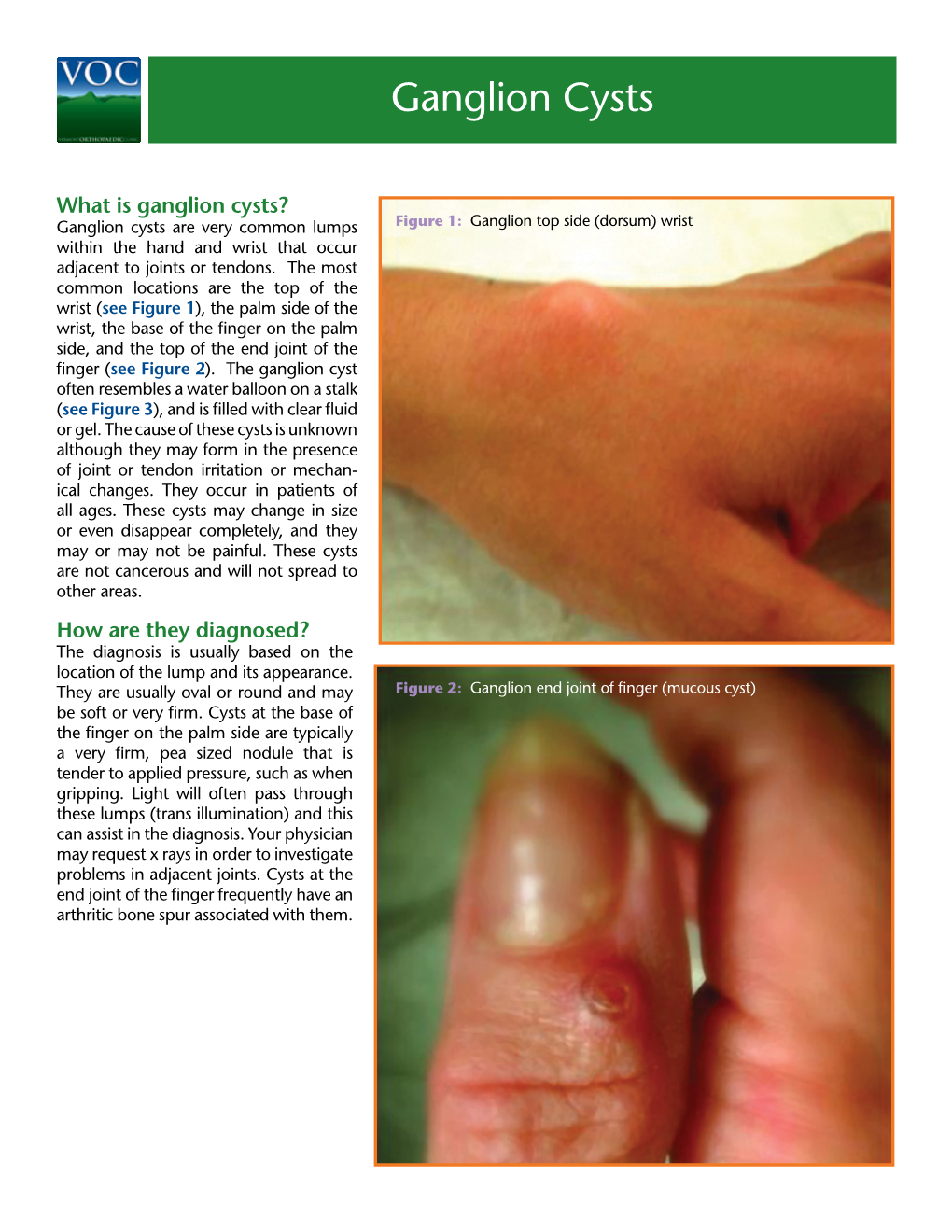 Ganglion Cysts