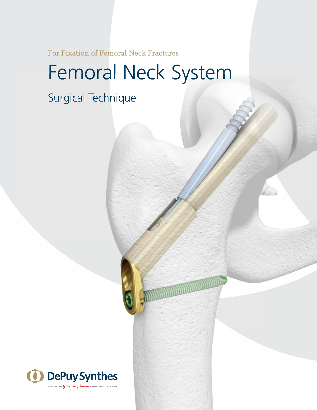 Femoral Neck System Surgical Technique Table of Contents