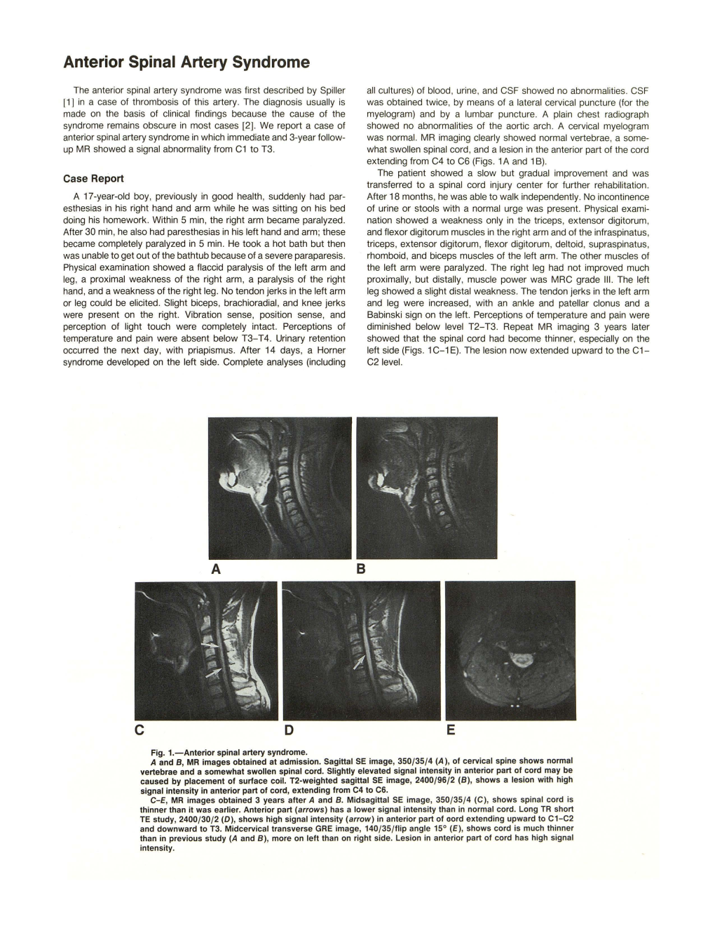 Anterior Spinal Artery Syndrome