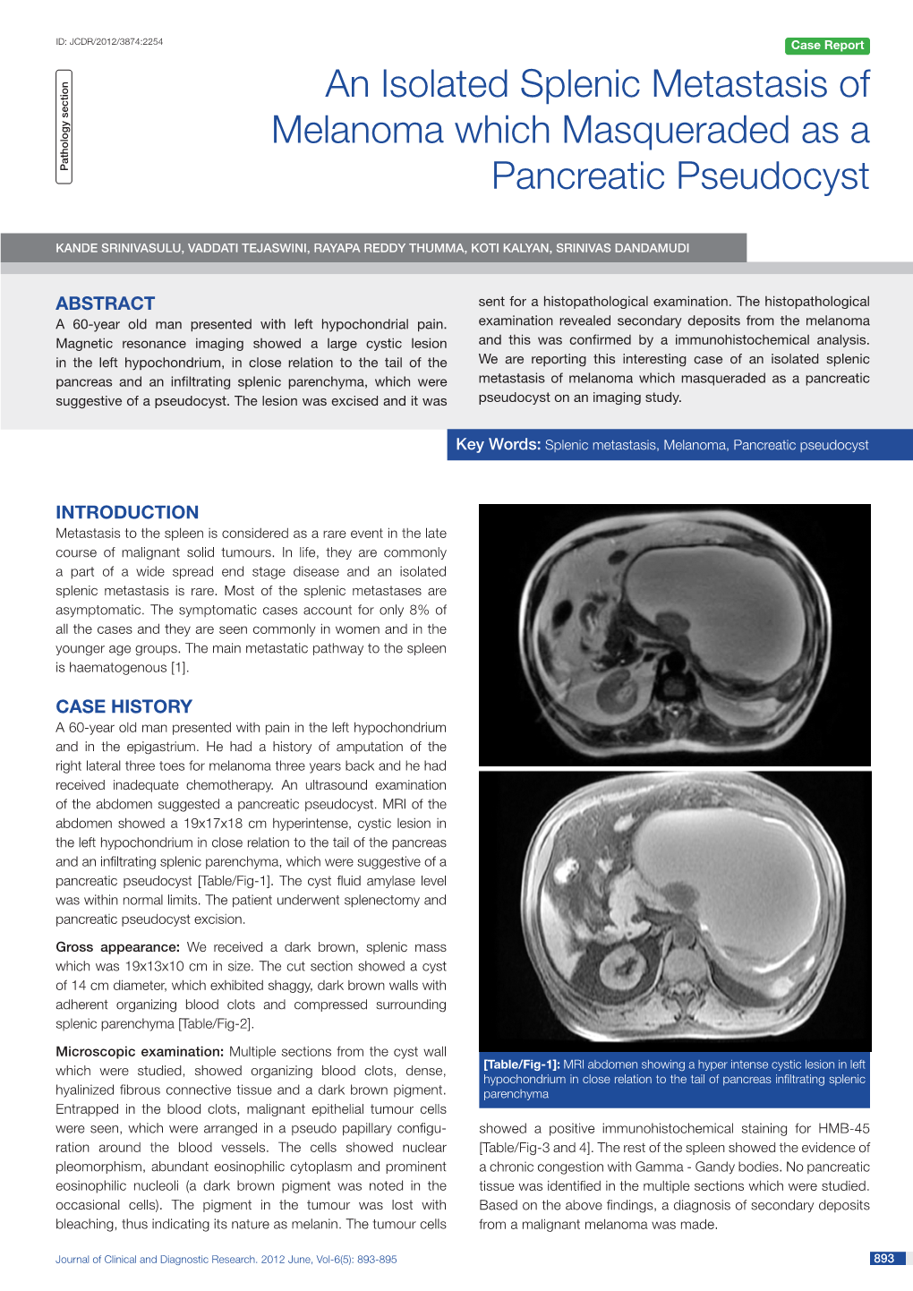 An Isolated Splenic Metastasis of Melanoma Which Masqueraded As a P Athology Section Pancreatic Pseudocyst