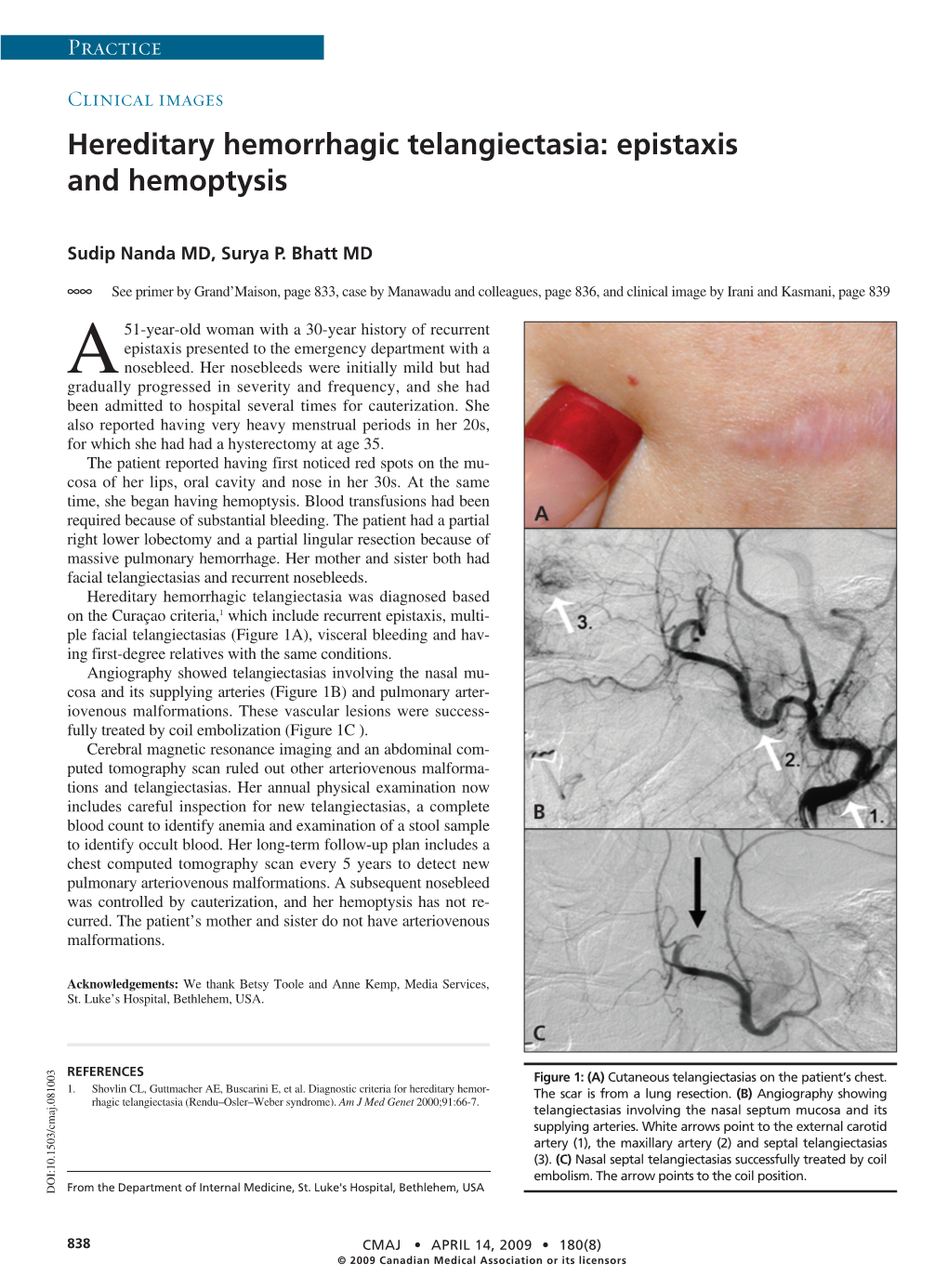 Hereditary Hemorrhagic Telangiectasia: Epistaxis and Hemoptysis