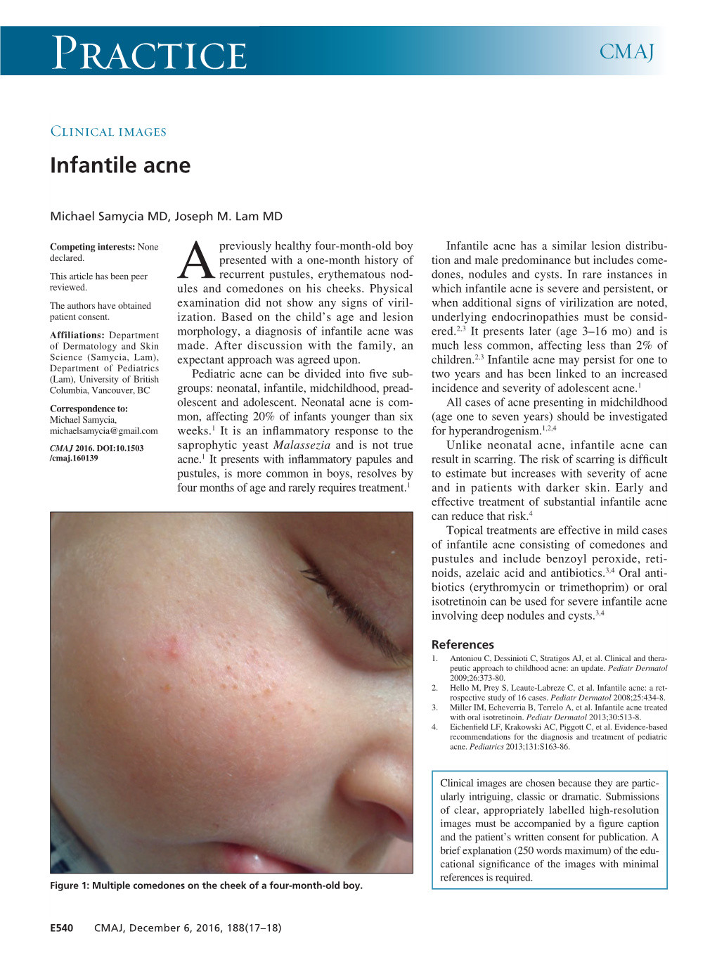 Infantile Acne