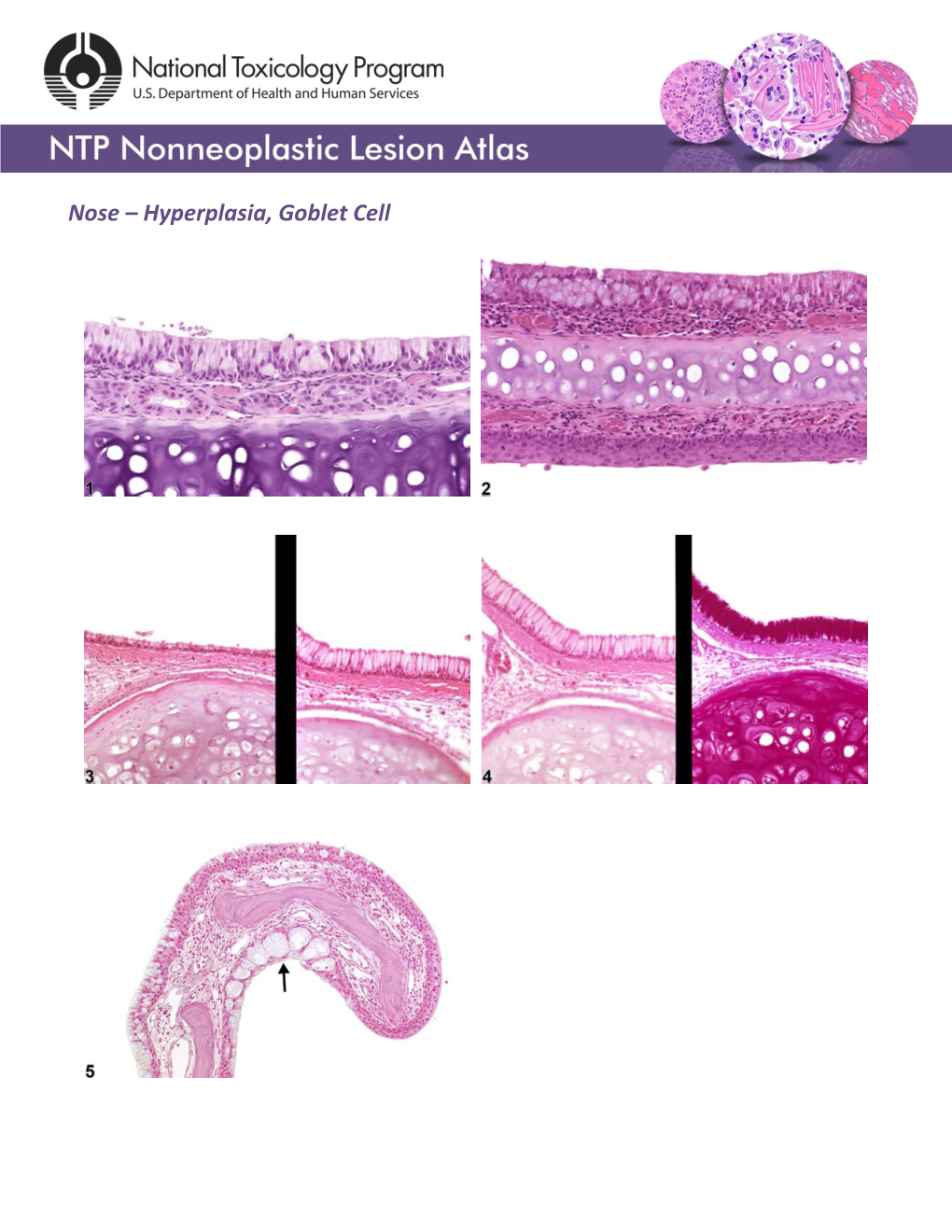 Nose – Hyperplasia, Goblet Cell