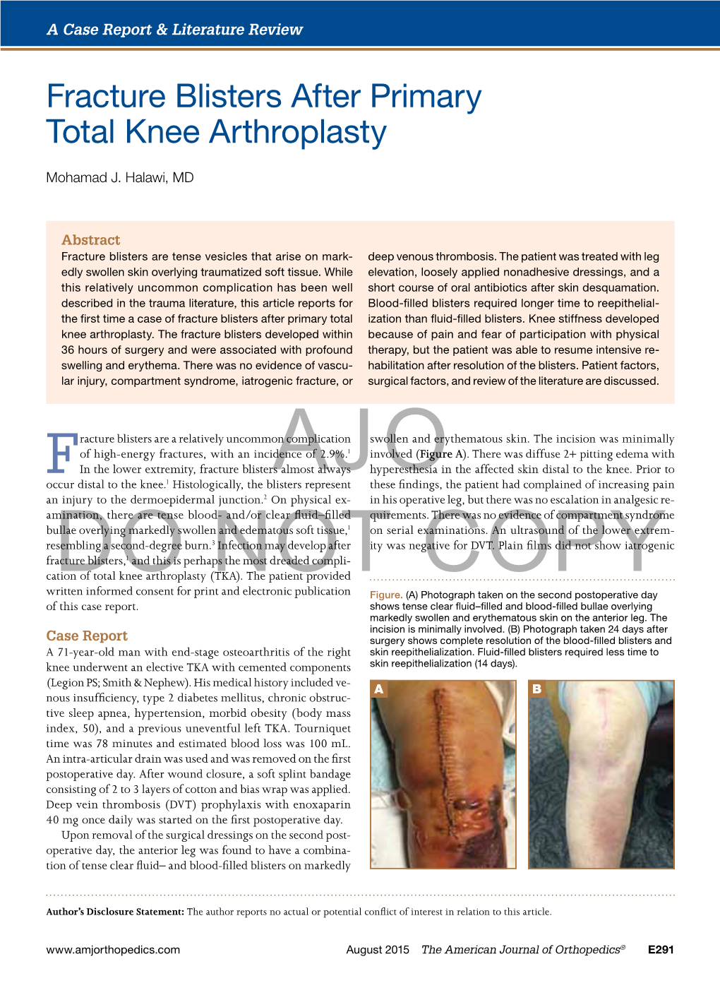 Fracture Blisters After Primary Total Knee Arthroplasty