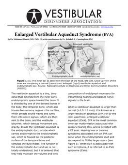 Enlarged Vestibular Aqueduct Syndrome