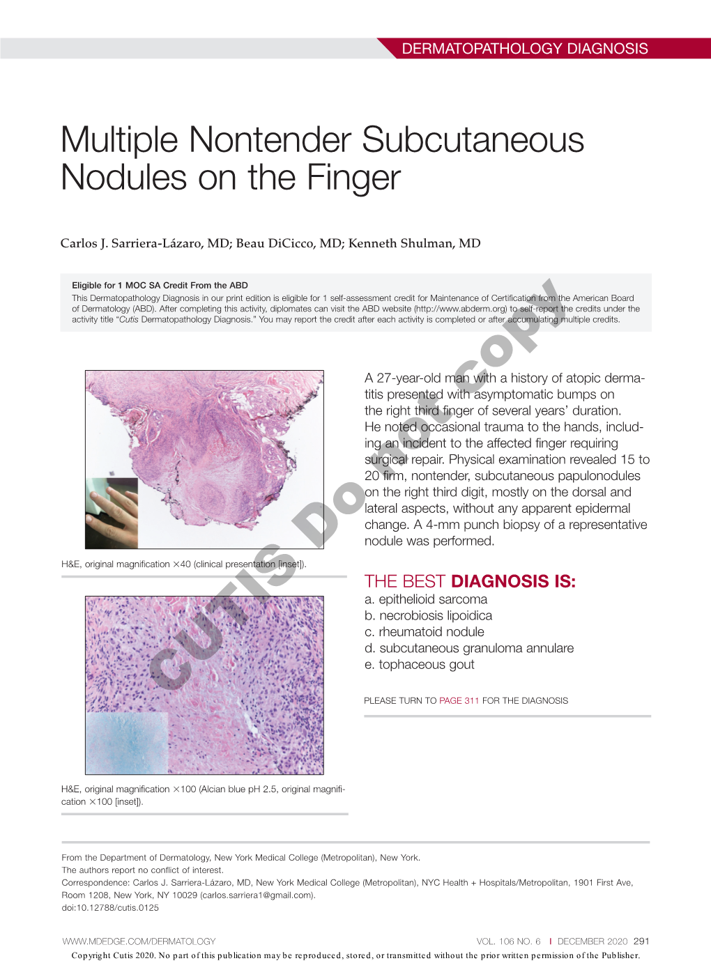 Multiple Nontender Subcutaneous Nodules on the Finger