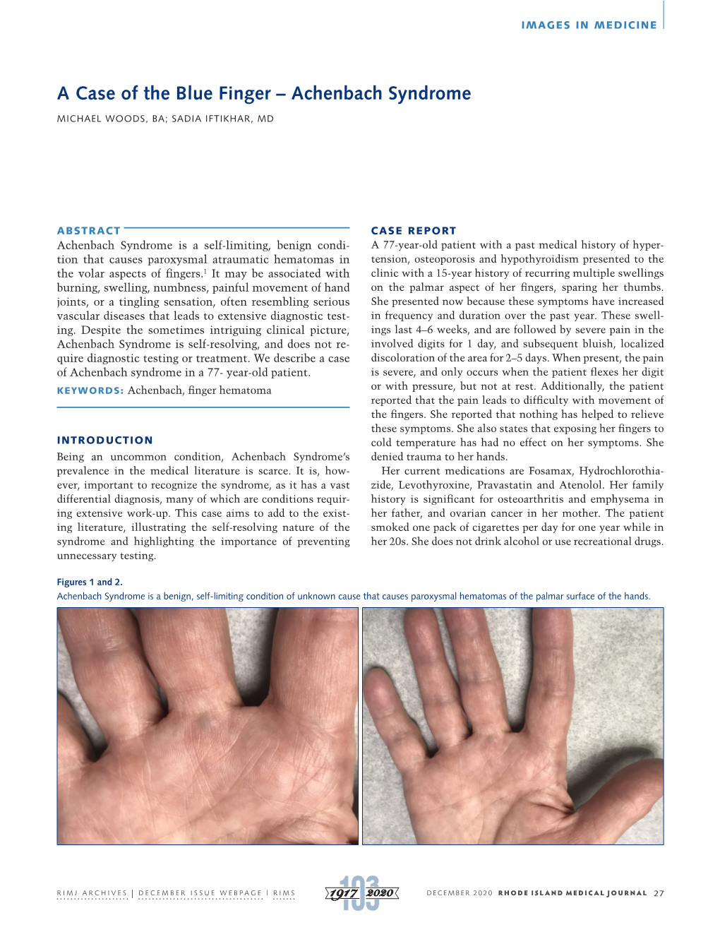 A Case of the Blue Finger – Achenbach Syndrome