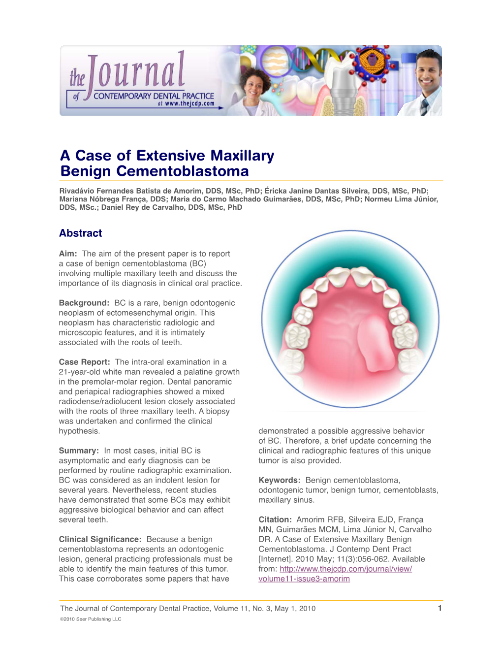 A Case of Extensive Maxillary Benign Cementoblastoma