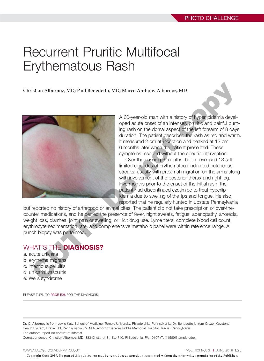 Recurrent Pruritic Multifocal Erythematous Rash