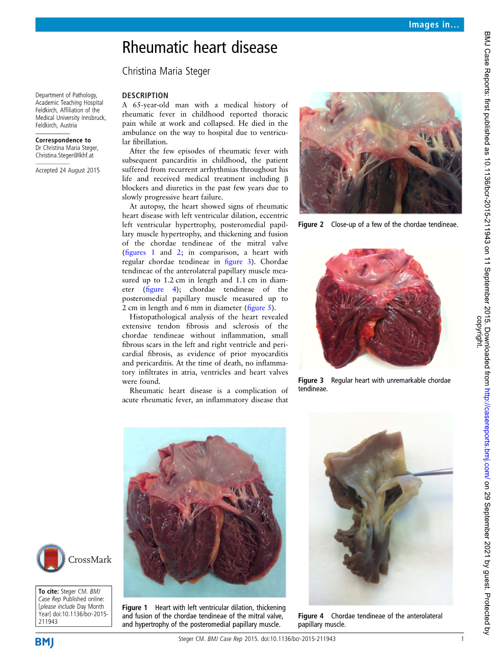 Rheumatic Heart Disease Christina Maria Steger